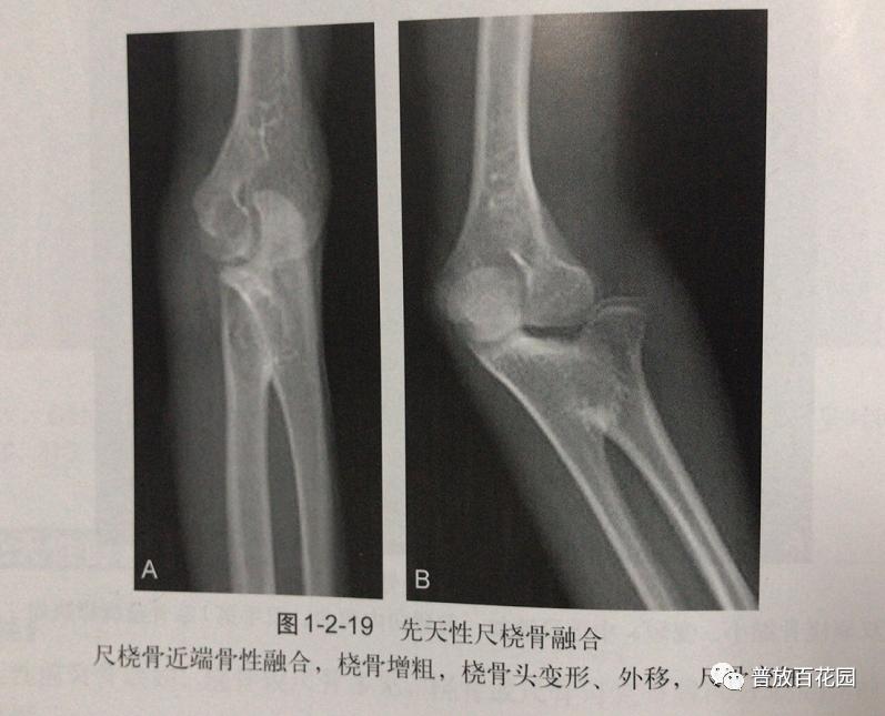 尺橈骨融合最新方法，探索前沿技術(shù)以優(yōu)化治療結(jié)果